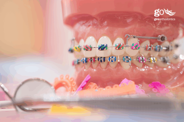 Does Dental Insurance Cover Orthodontic Treatment?