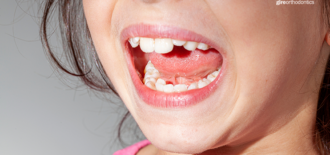 Is Phase One Orthodontic Treatment Necessary?