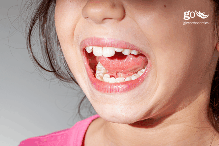 Is Phase One Orthodontic Treatment Necessary?