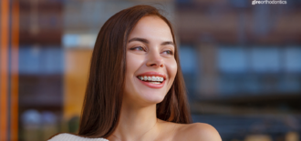 Do I Need Braces as an Adult?