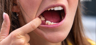 What to Know About Braces and Missing Teeth