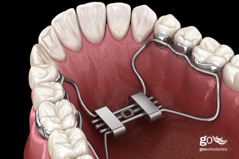 Do I Need a Palatal Expander?
