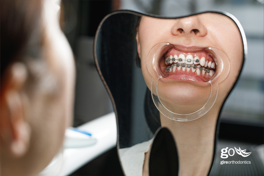 cost of braces without insurance