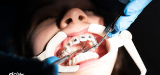 How Long Does It Take to Get Braces?