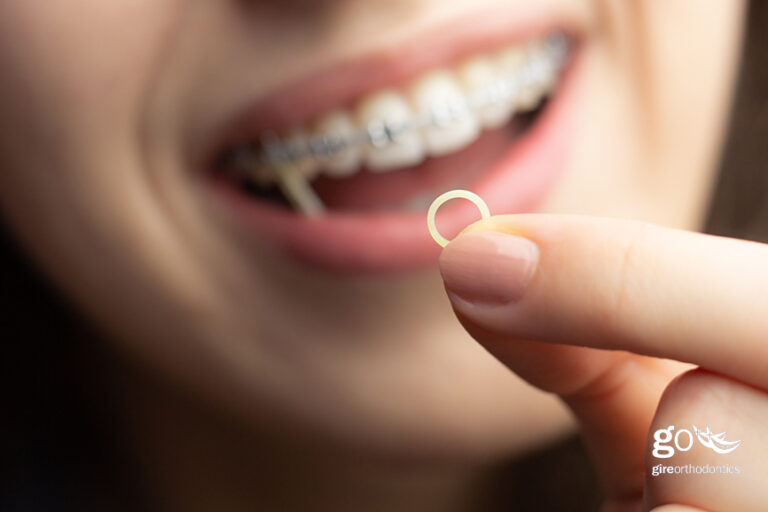 How Often Should I Change Rubber Bands?