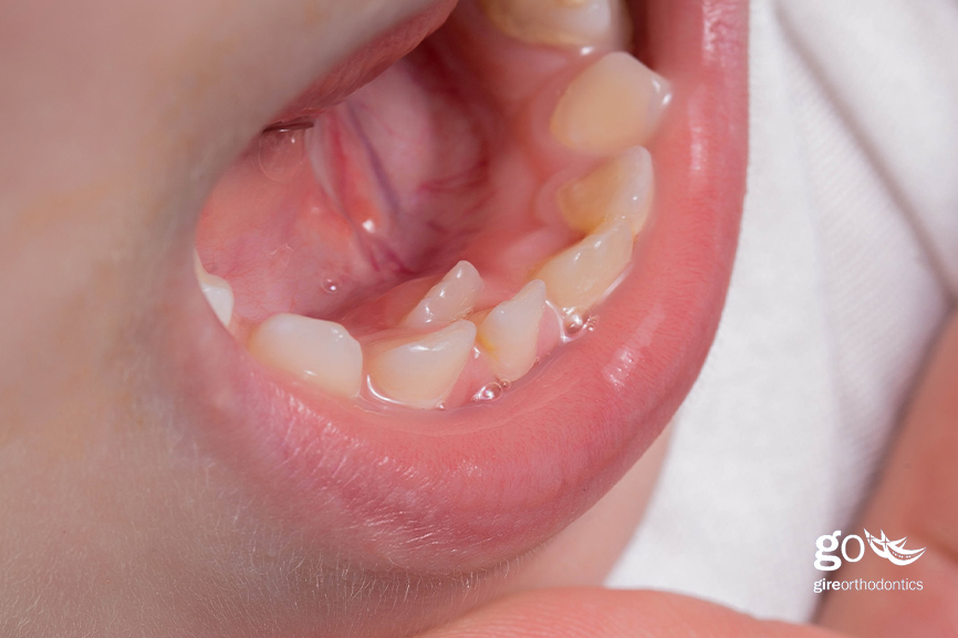supernumerary teeth braces or extraction
