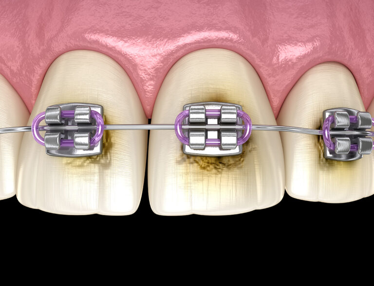 Will Braces Stain My Teeth Understand Prevent Treat Braces Stains will-braces-stain-my-teeth-understand-prevent-treat-braces-stains
