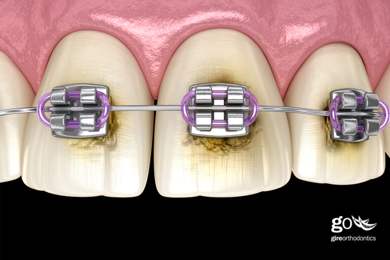 Will Braces Stain My Teeth?