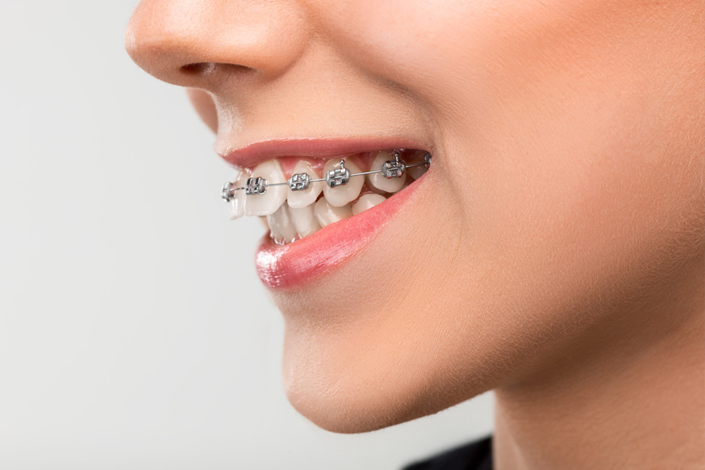 Correct bite