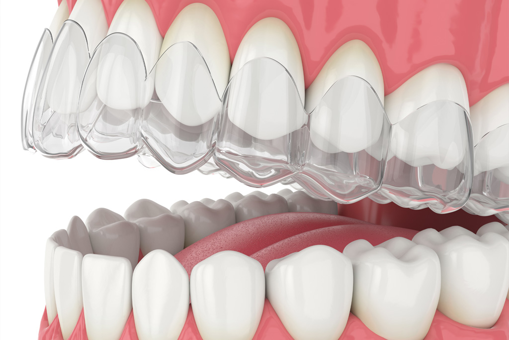when are clear aligners the clear choice