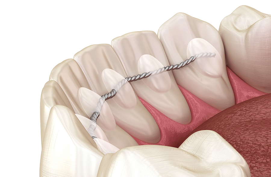 fixed retainers