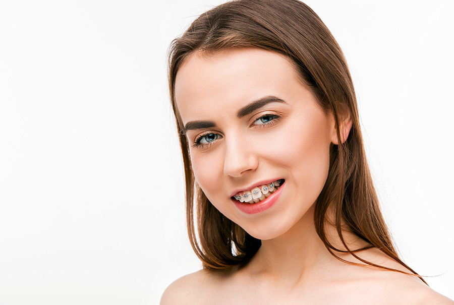 Self-Ligating Braces