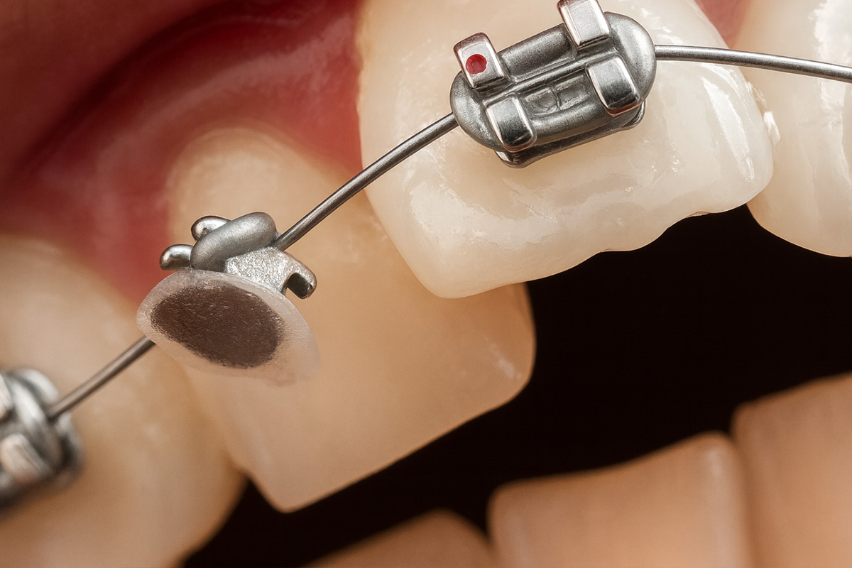 Loose or Broken Brackets