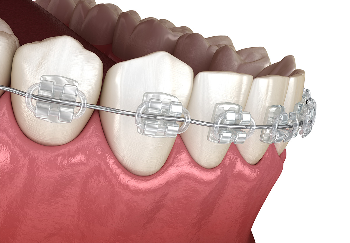 Ceramic/Clear Braces