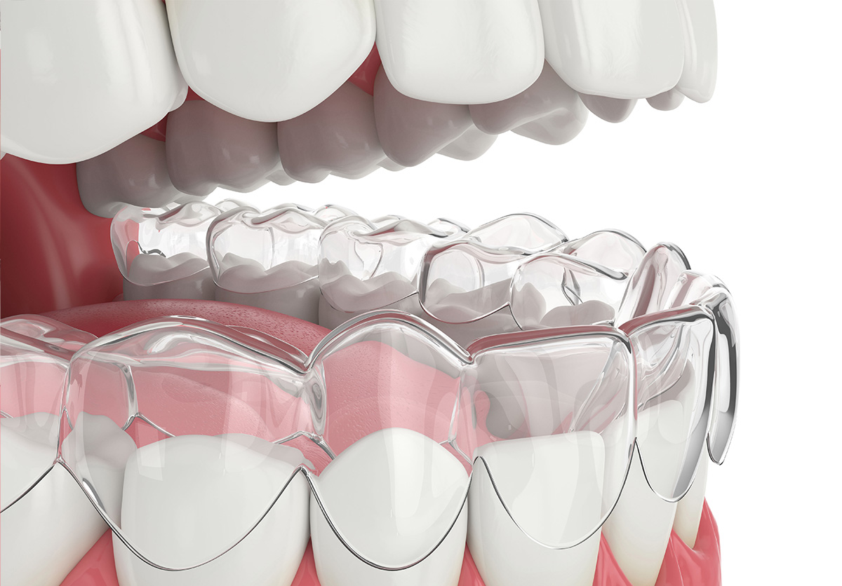 Clear Aligners
