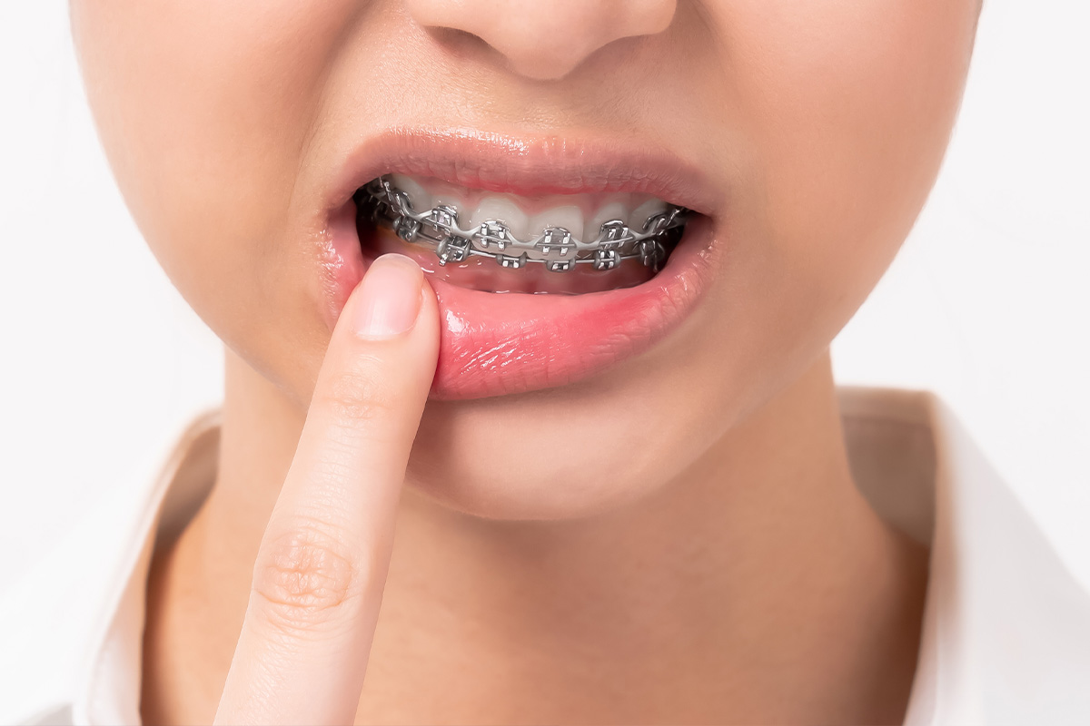 Discomfort from Braces and Appliances