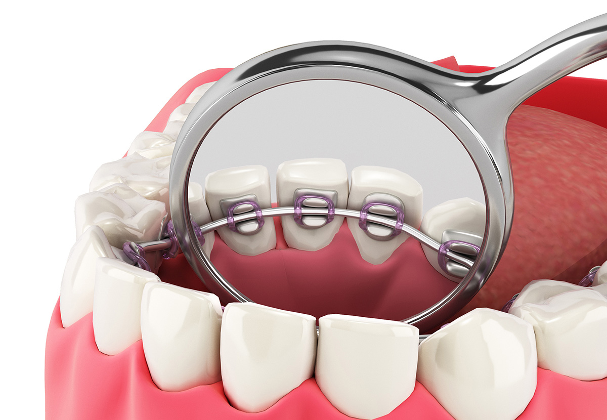 Lingual (Behind the Tooth) Braces