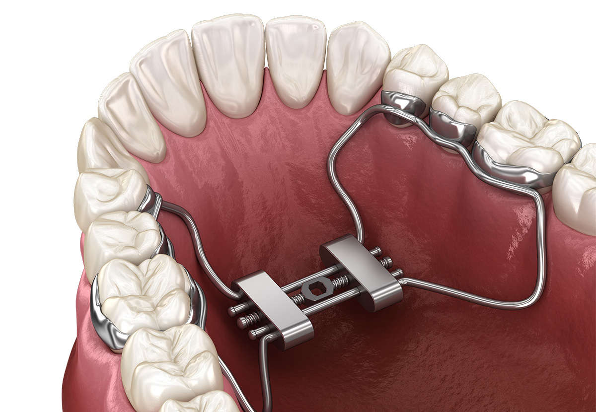 Orthodontic Appliances