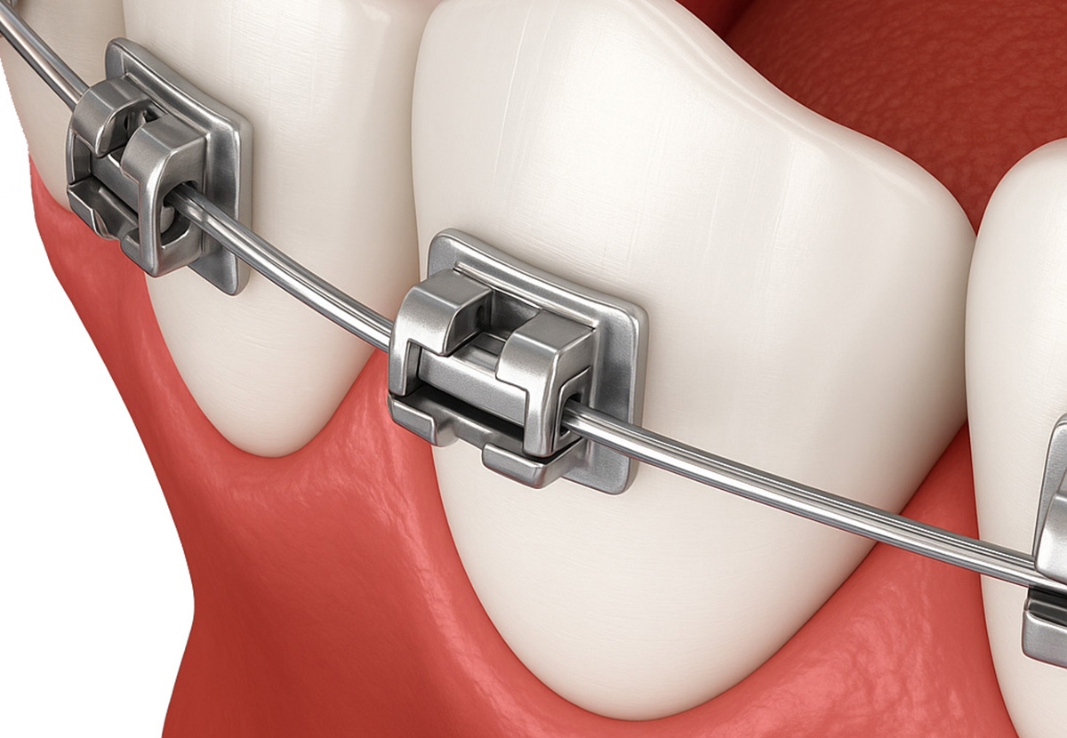 Self-Ligating Braces