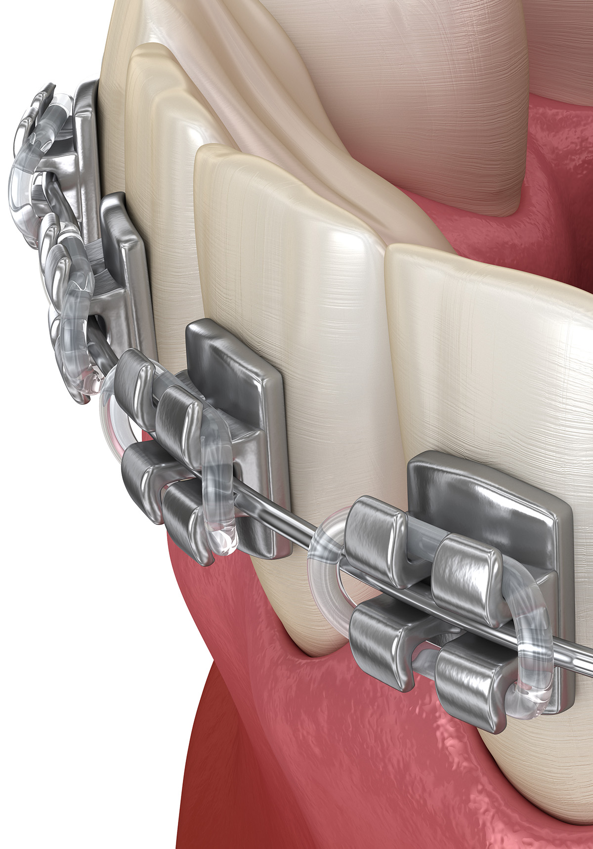 Traditional Metal Braces
