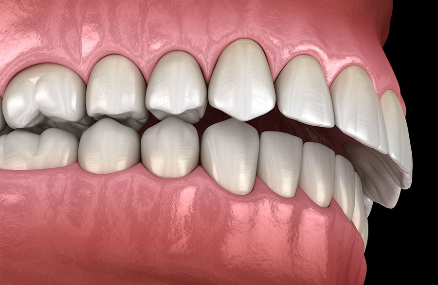 Overbites or Deep-bites