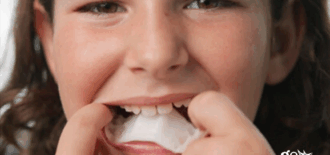 Invisalign Offers New Palatal Expander