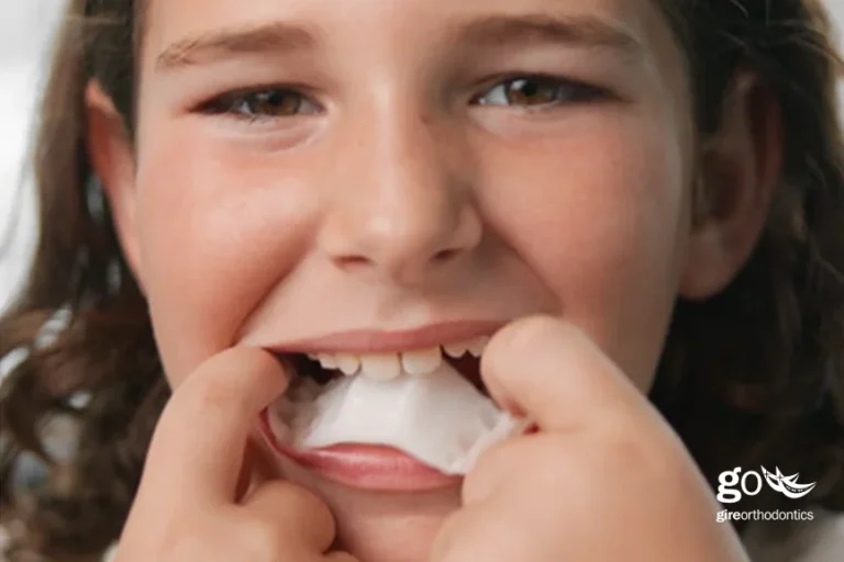 Invisalign Offers New Palatal Expander