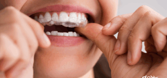 Spark or Invisalign – Which is Better?
