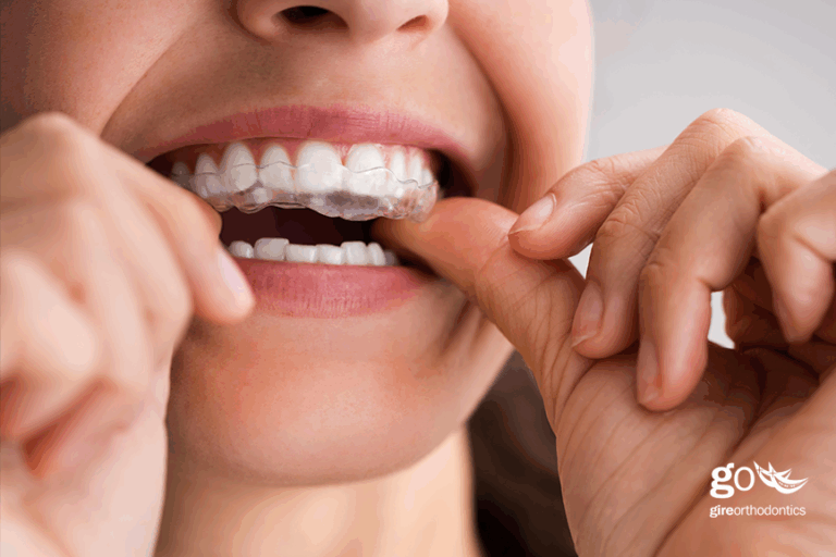 Spark or Invisalign – Which is Better?