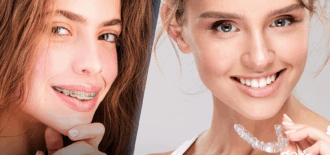 Which Braces are the Fastest?