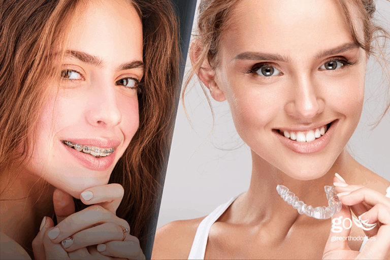 Which Braces are the Fastest?