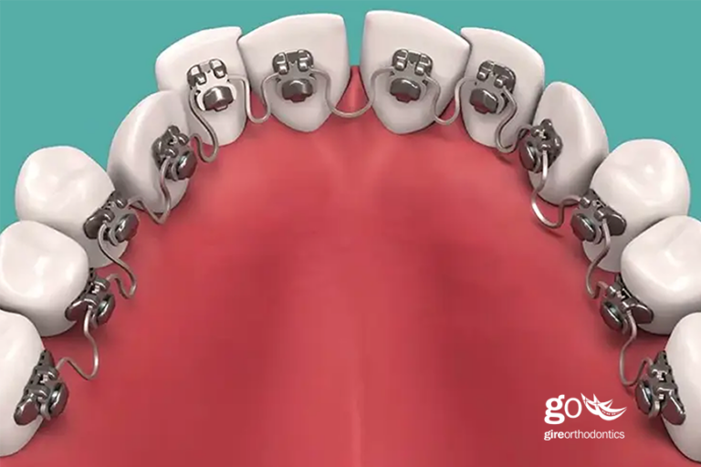 InBrace to InSmile – Why We Should Remain Cautious