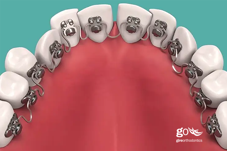 InBrace to InSmile – Why We Should Remain Cautious