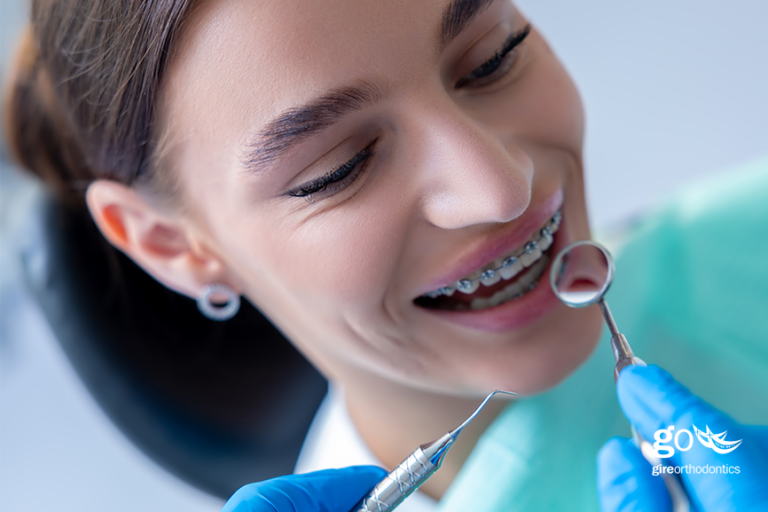 How Much Do Braces Cost for Adults?